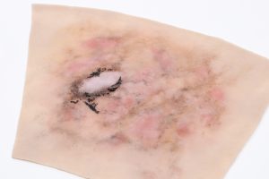 Forearm Self-Adhesive: Fire Burn 0-2 hours Loading...