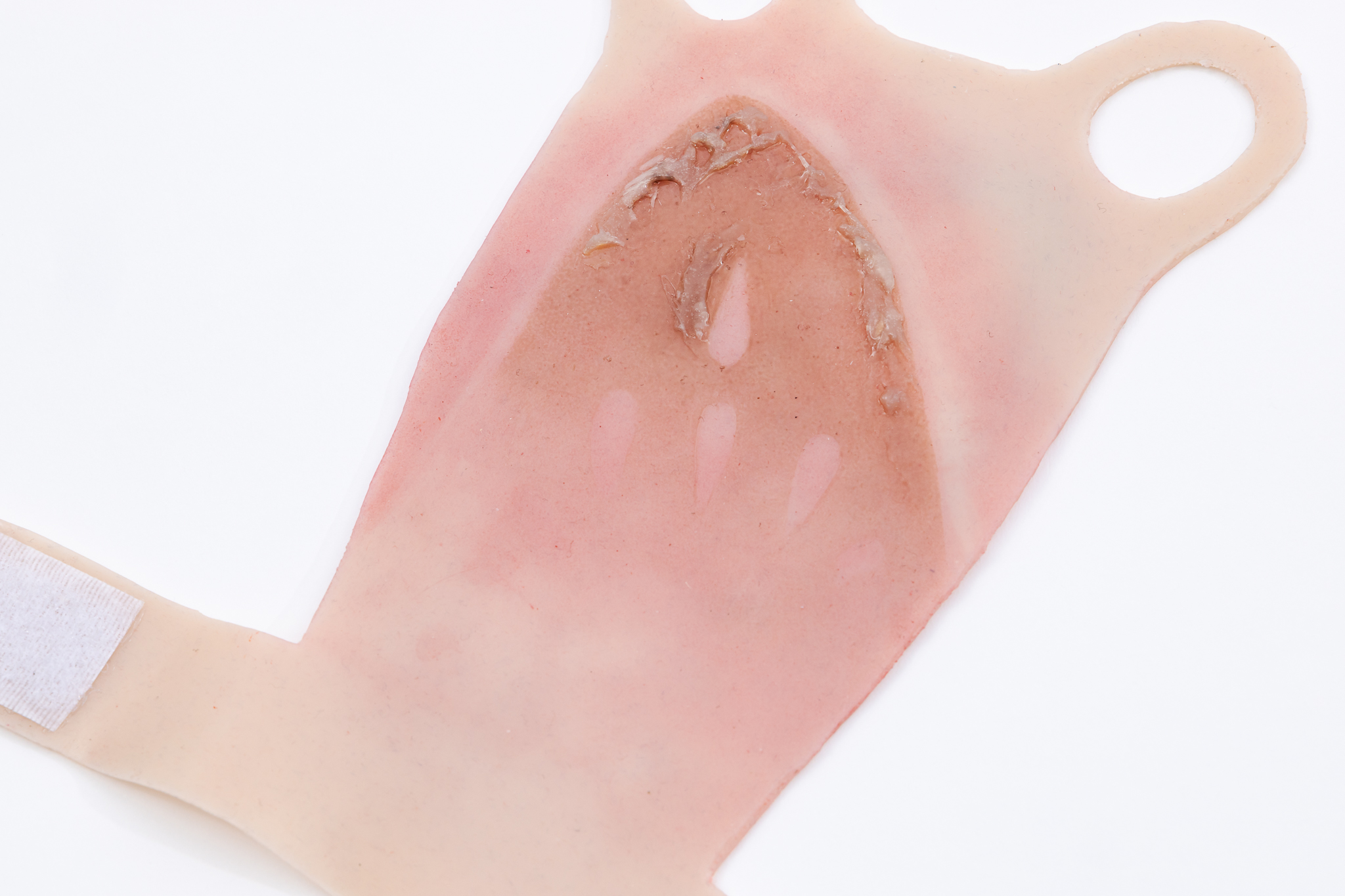 Reversible Hand Contact Burn - Image 8