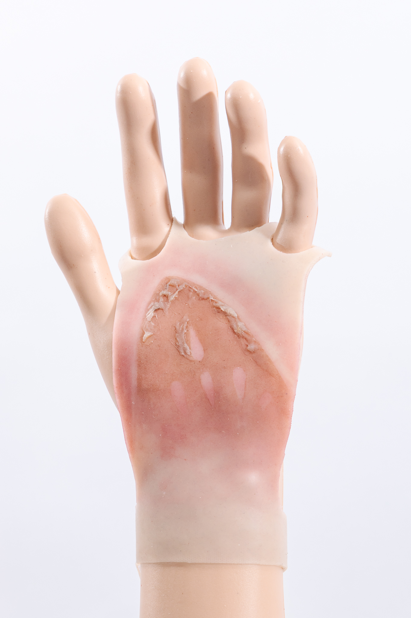 Reversible Hand Contact Burn - Image 3