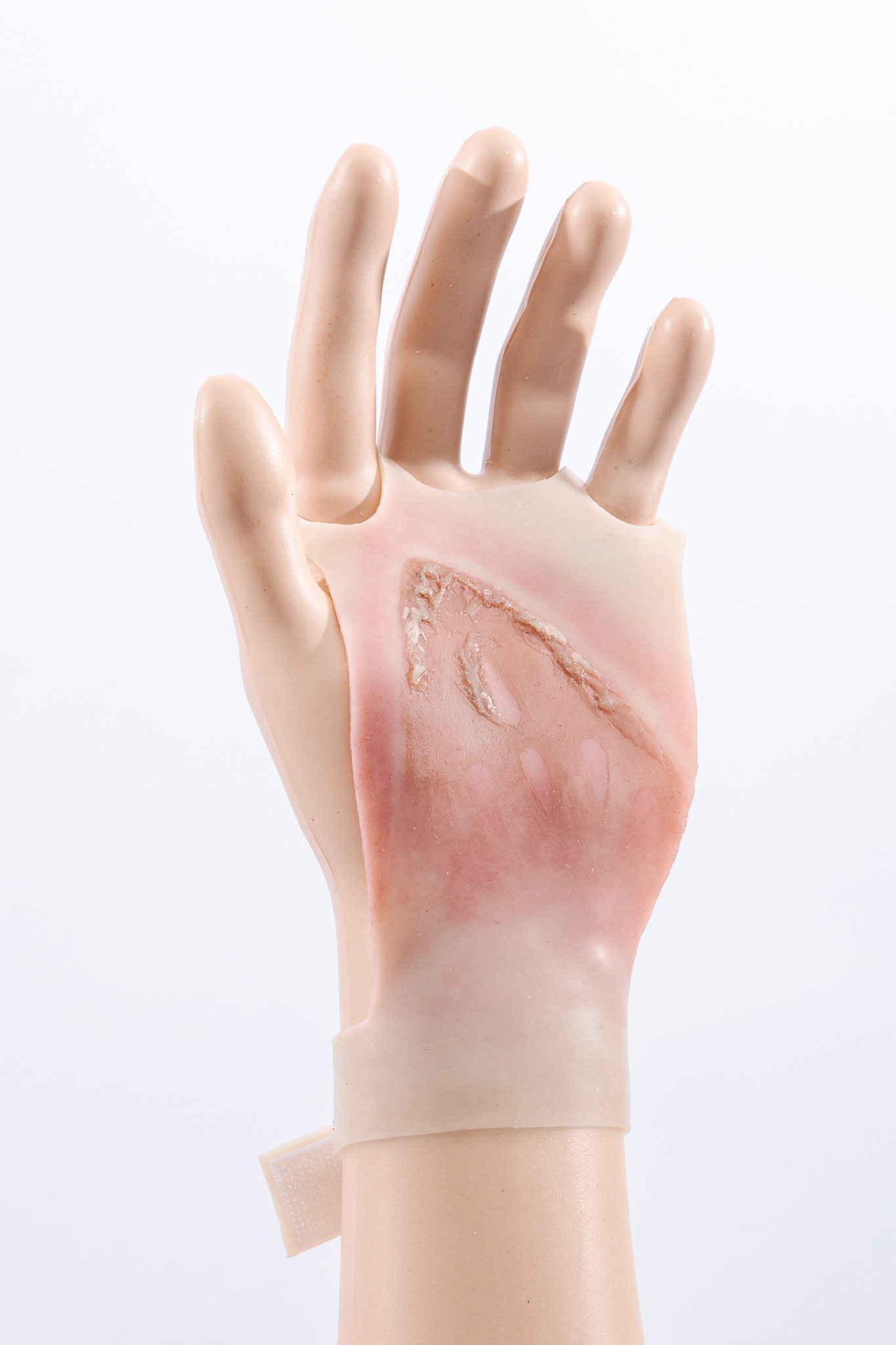 Reversible Hand Contact Burn - Image 4