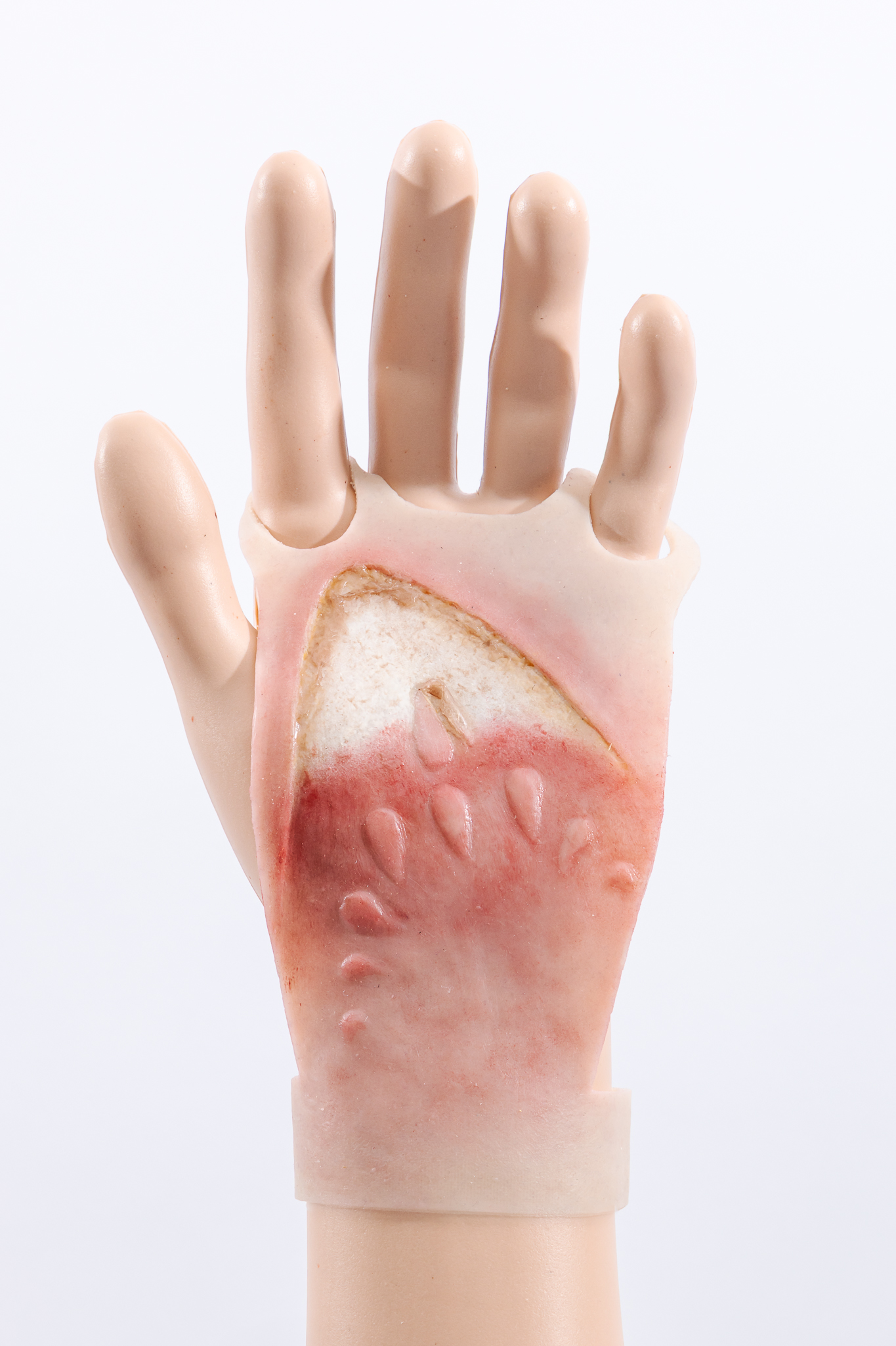 Reversible Hand Contact Burn - Image 5