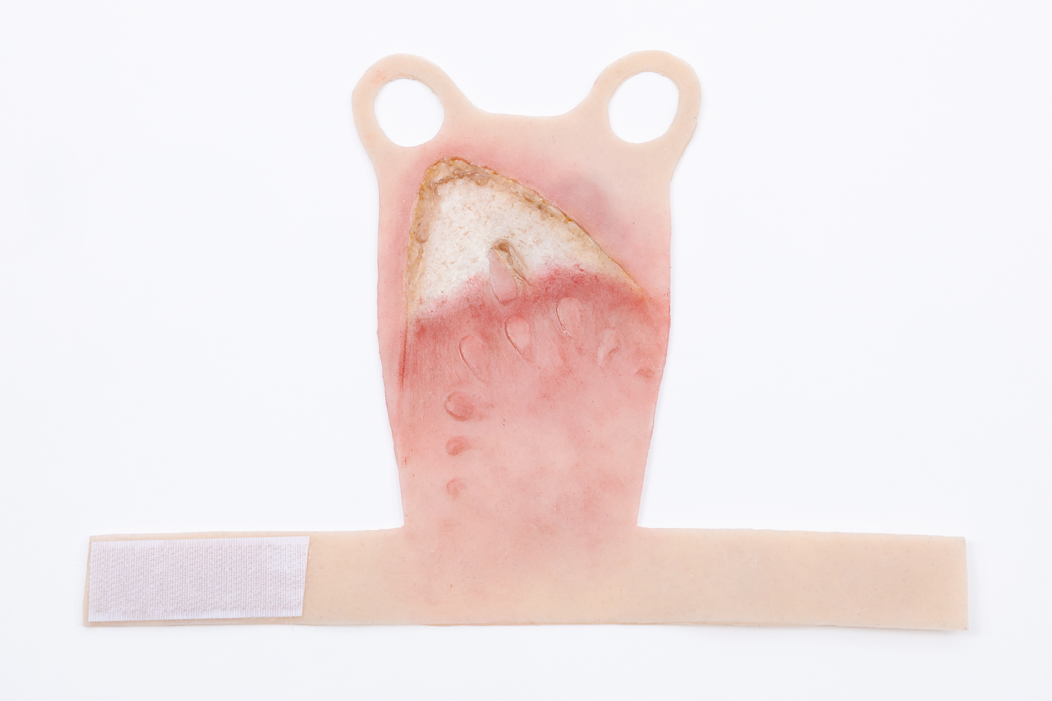 Reversible Hand Contact Burn - Image 10