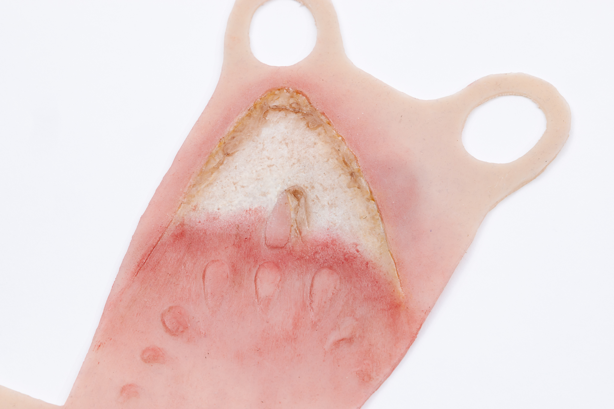 Reversible Hand Contact Burn - Image 9