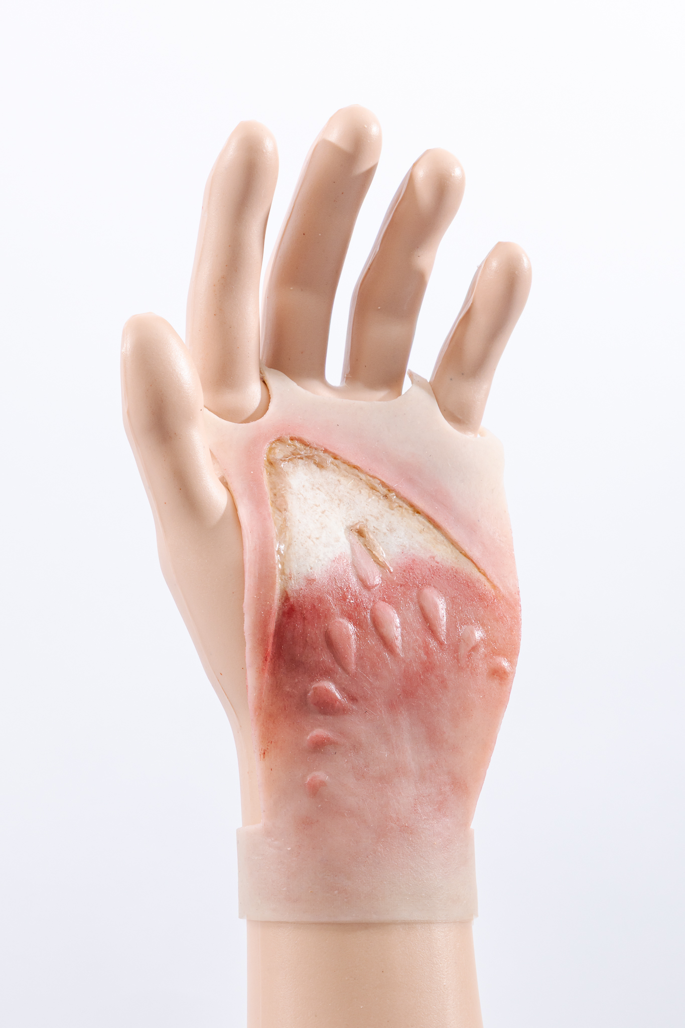 Reversible Hand Contact Burn - Image 6