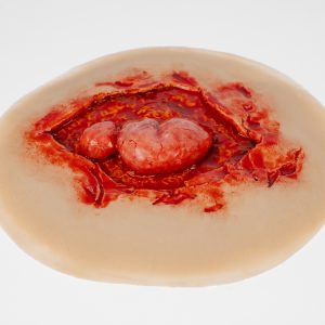 Evisceration with Open Wound