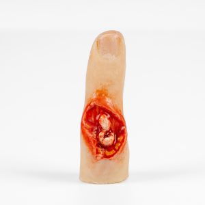 Finger Glove - Exposed Bone Injury