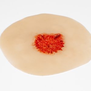 Gunshot Exit Wound Medium