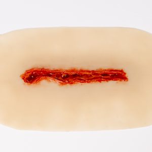Laceration Elongated