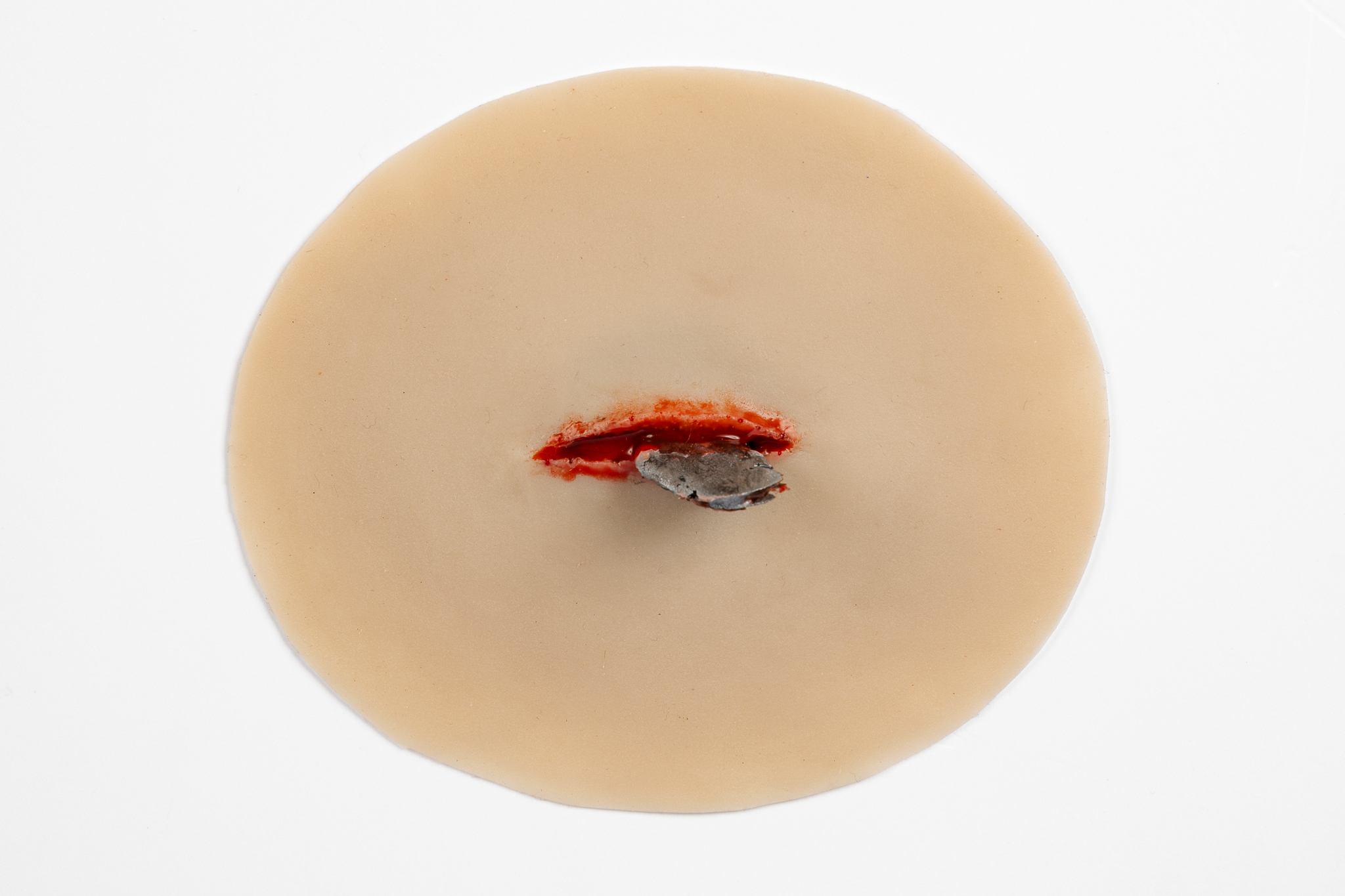 Wound with Metal Fragment - Image 2