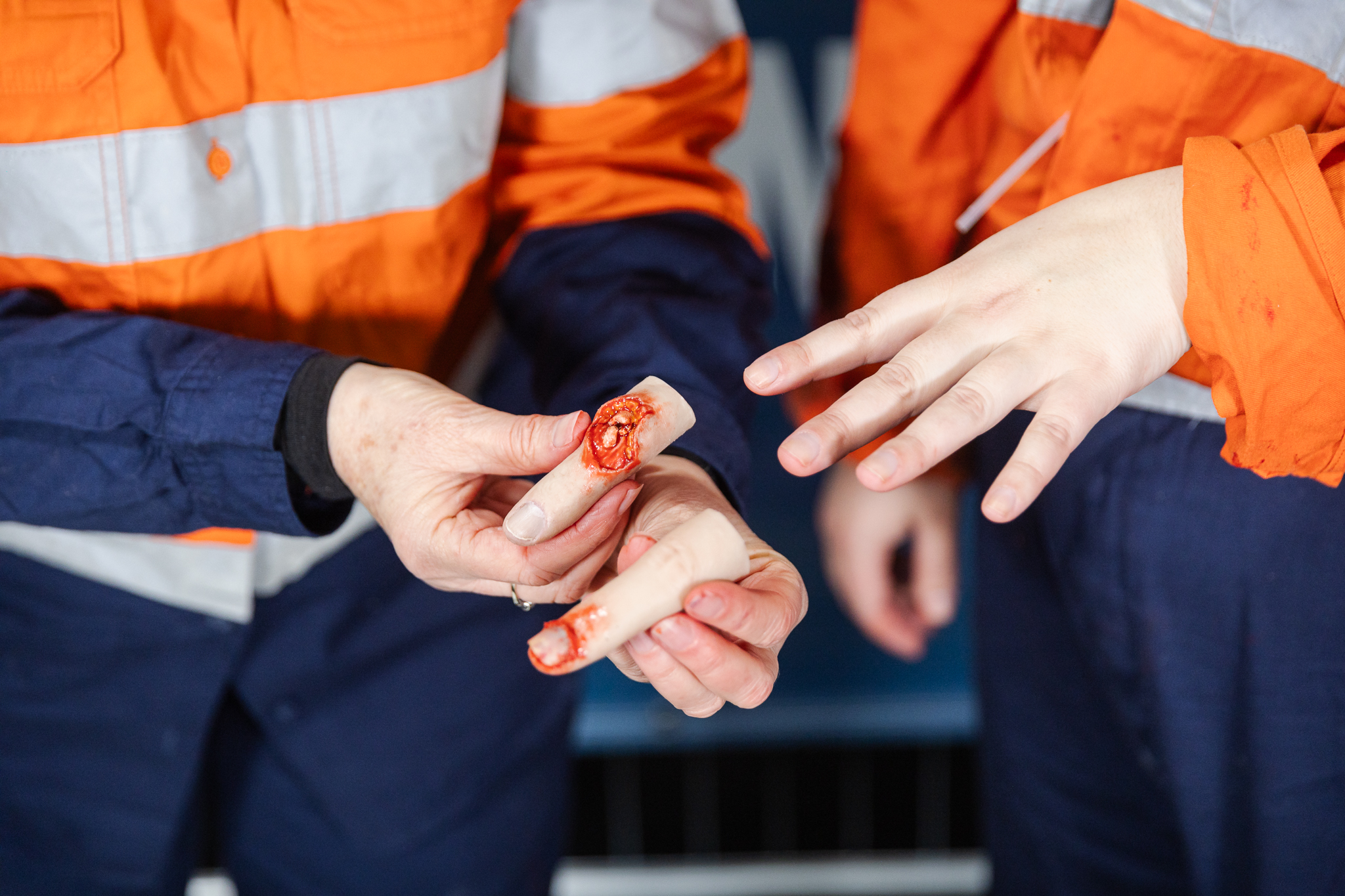 Finger Glove - Exposed Bone Injury - Image 5