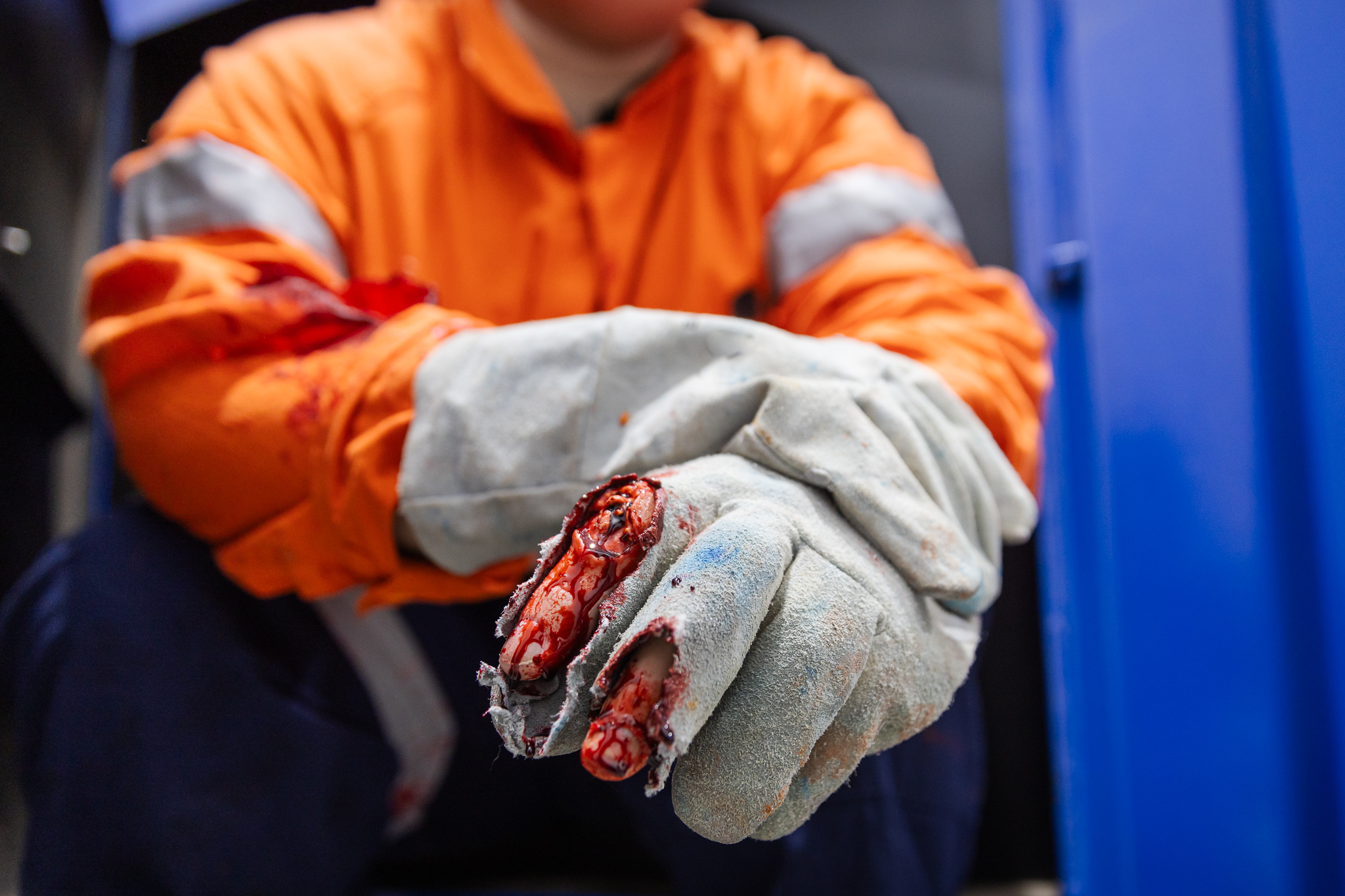 Finger Glove - Exposed Bone Injury - Image 10