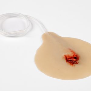 Compound Fracture Rib with Bleeding Capacity