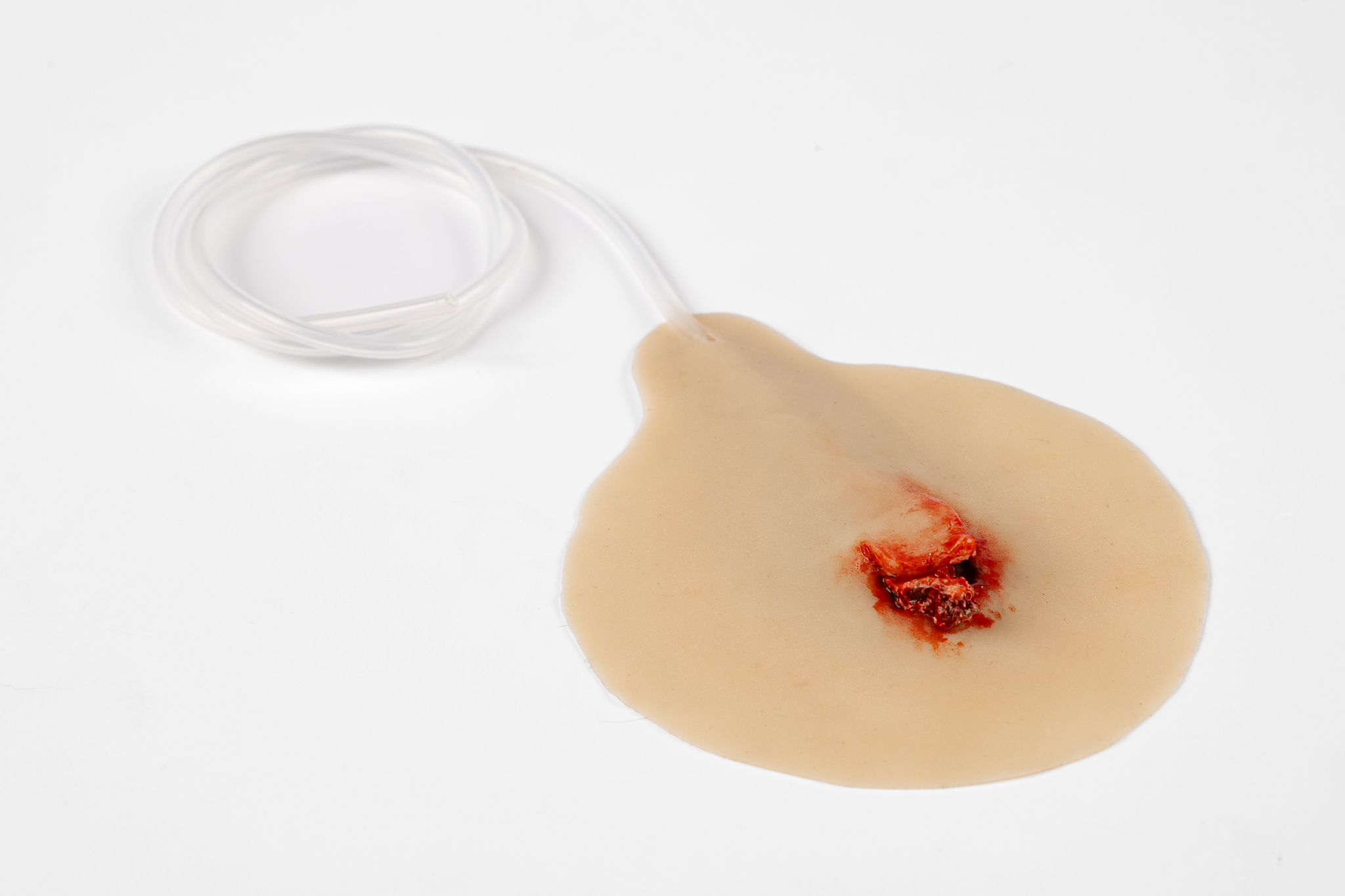 Compound Fracture Rib with Bleeding Capacity