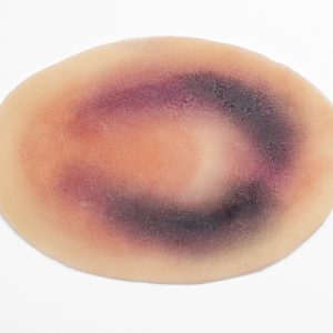 Small Haematoma