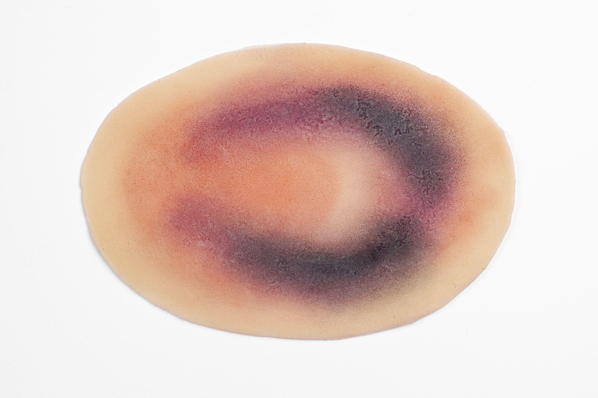 Small Haematoma