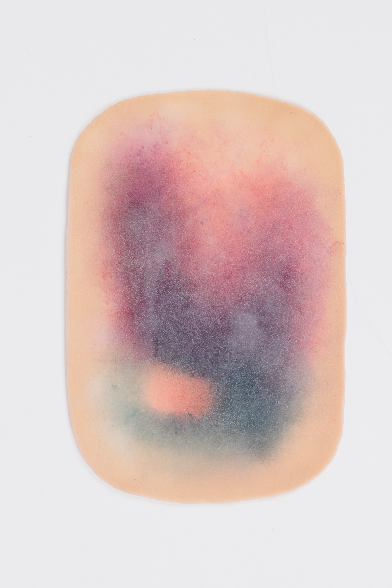 Large Haematoma - Image 2