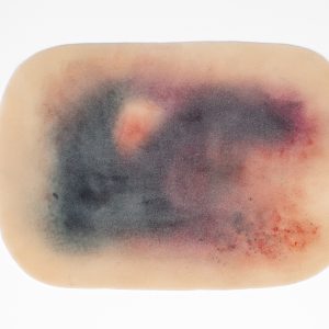 Large Haematoma