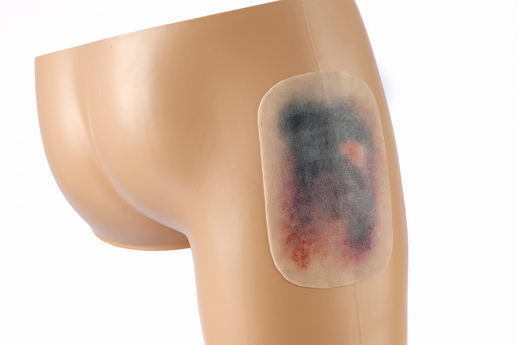 Large Haematoma - Image 7
