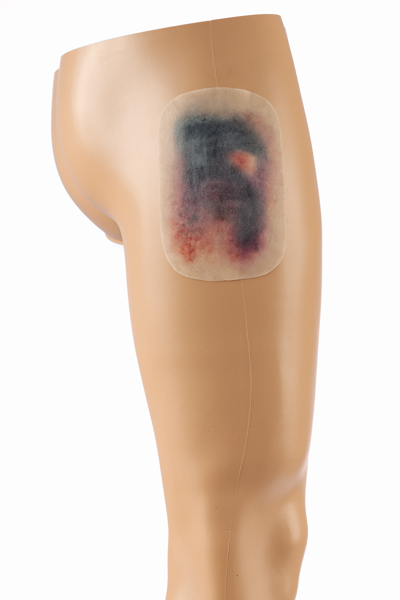 Large Haematoma - Image 3