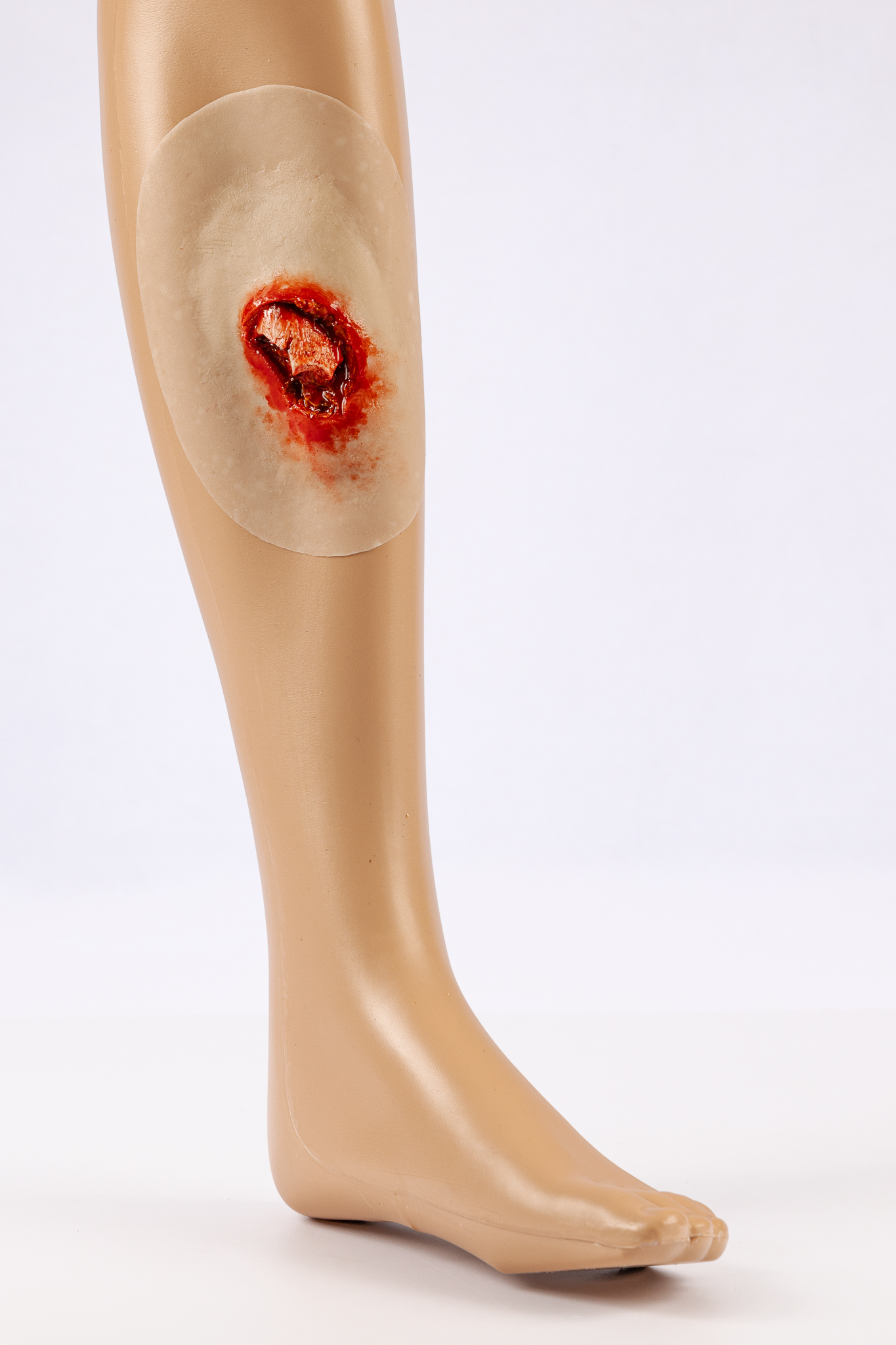 Open Fracture - Image 4