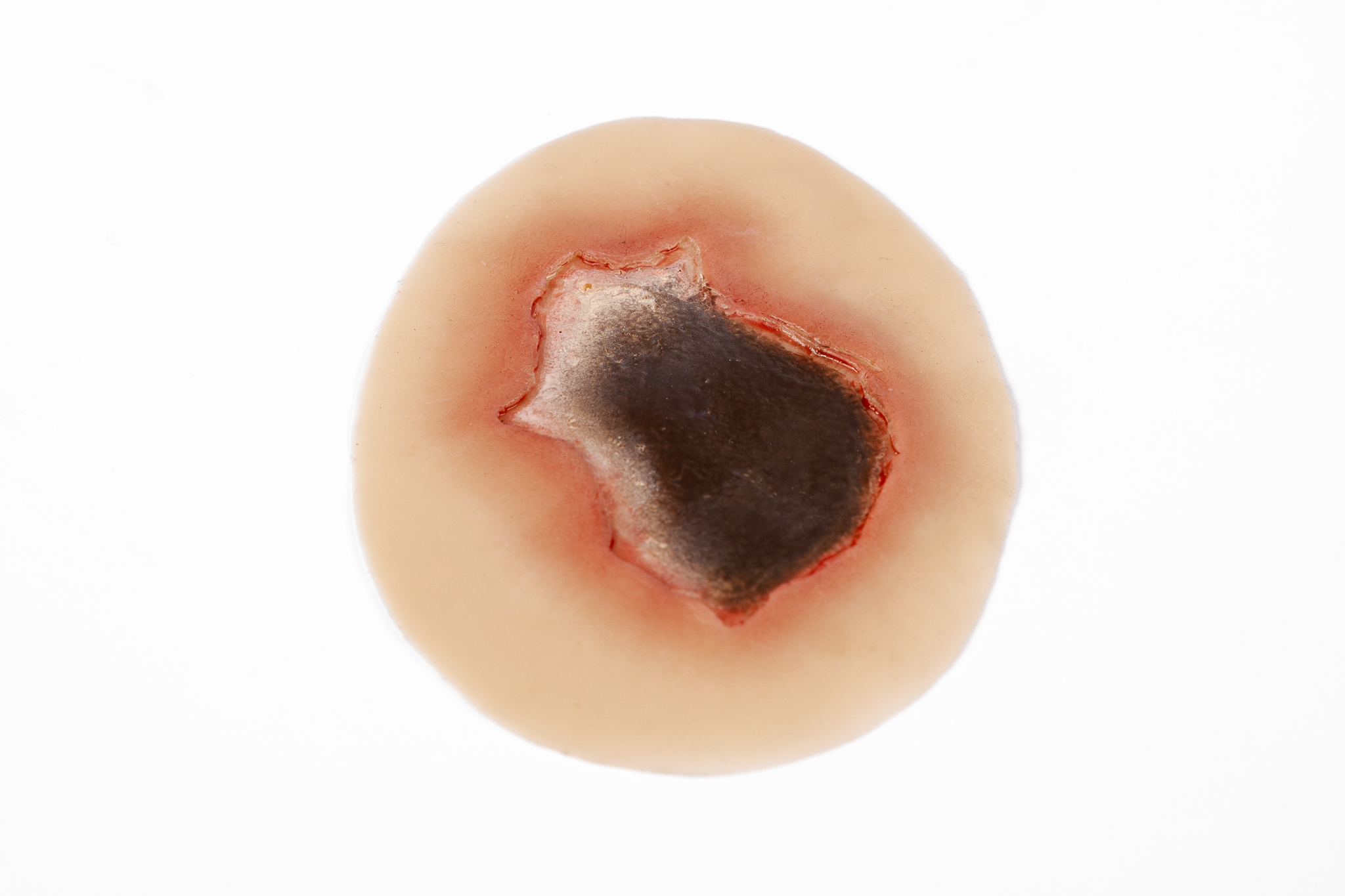 Pressure Injury - Unstageable - Image 2