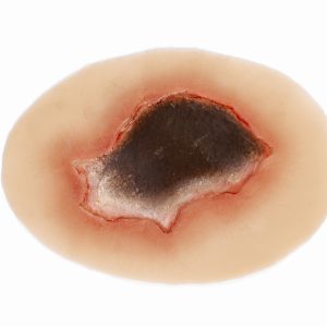 Pressure Injury - Unstageable