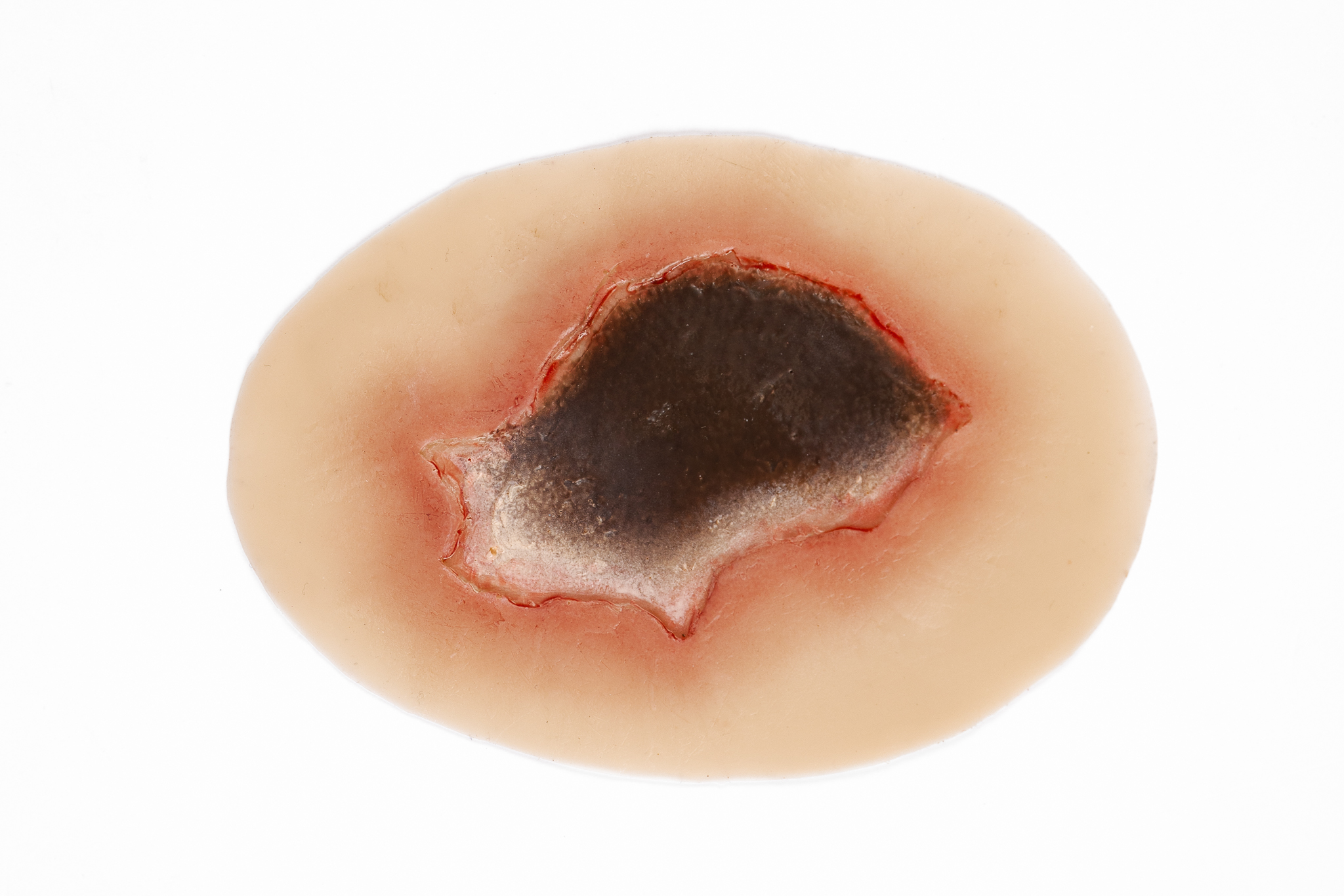 Pressure Injury - Unstageable