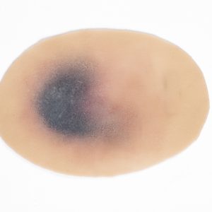 Pressure Injury - Suspected Deep Tissue