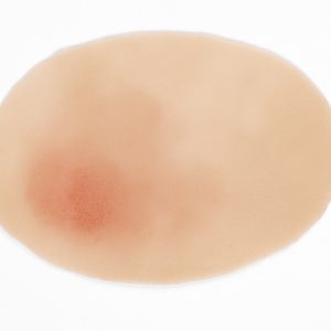 Pressure Injury Stage 1