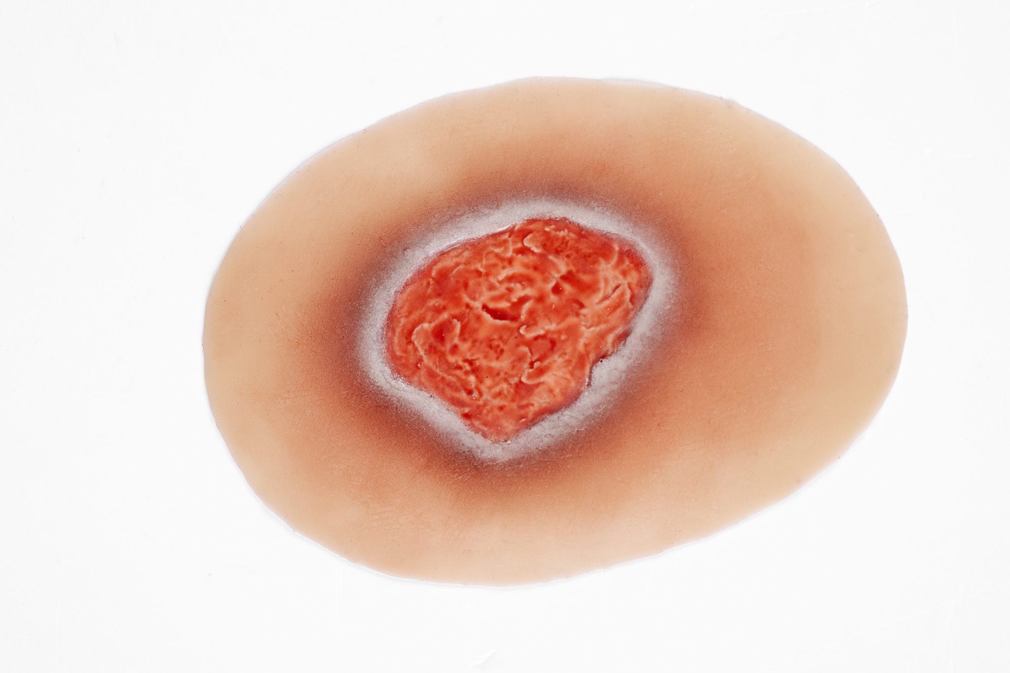 Clinical Pressure Injury Range - Image 5