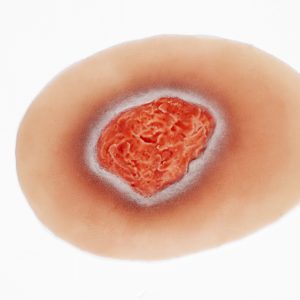 Pressure Injury - Stage 2