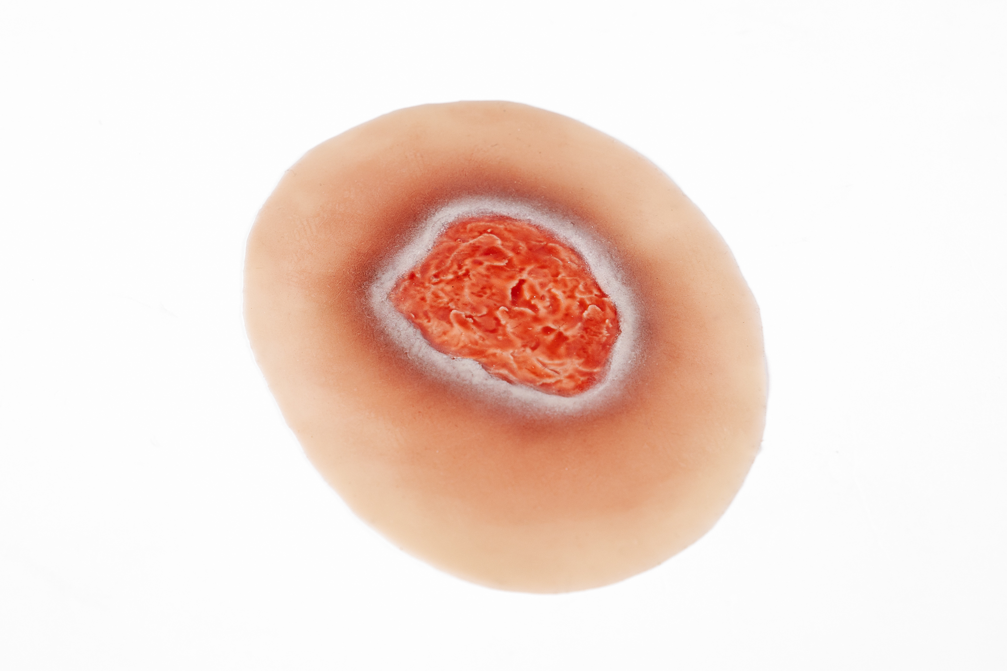 Pressure Injury - Stage 2 - Image 2