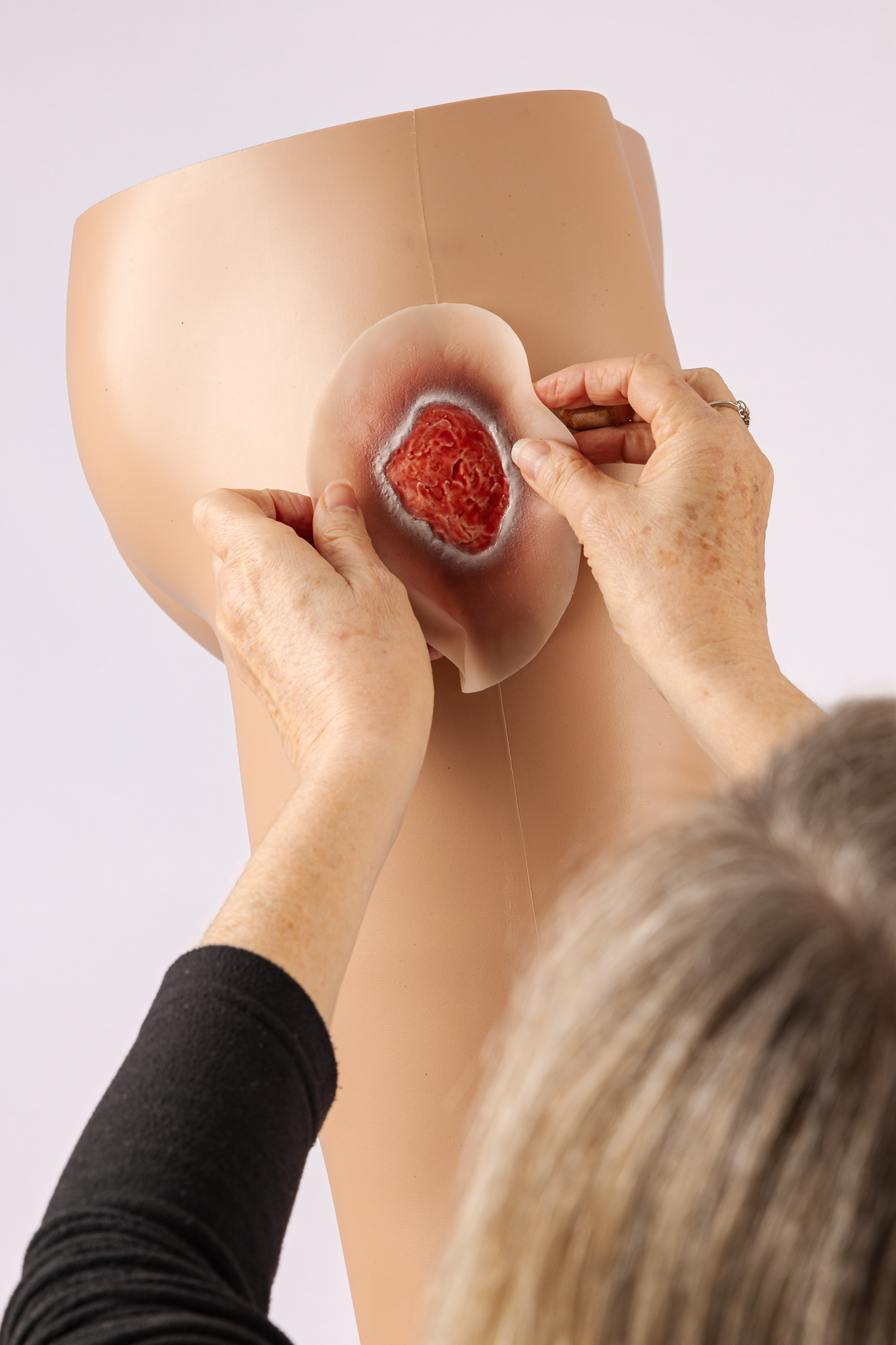 Pressure Injury - Stage 2 - Image 4