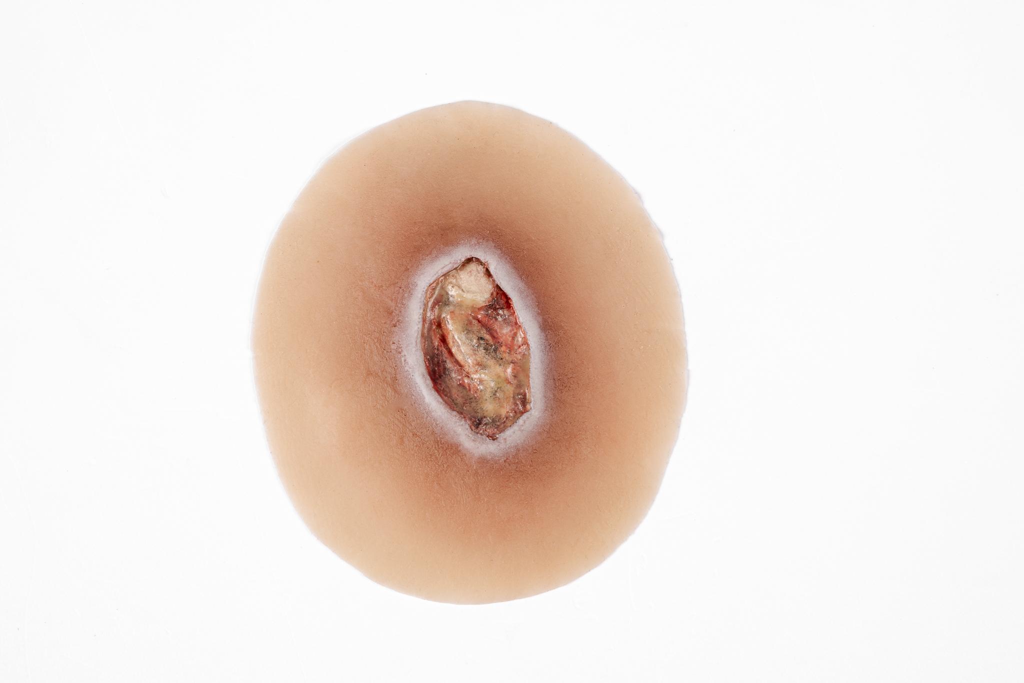 Clinical Pressure Injury Range - Image 10