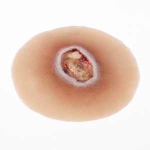 Pressure Injury - Stage 4