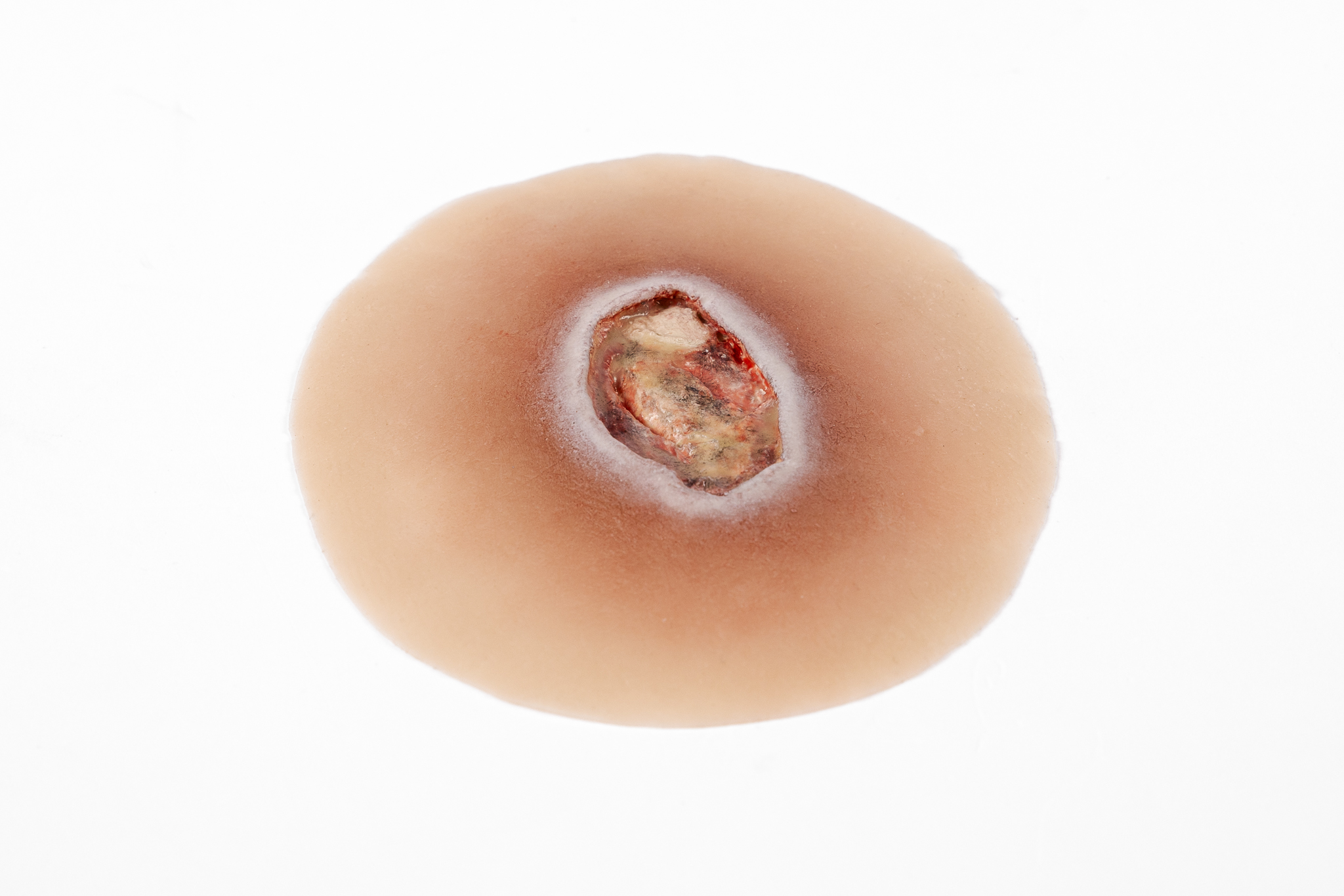 Pressure Injury - Stage 4