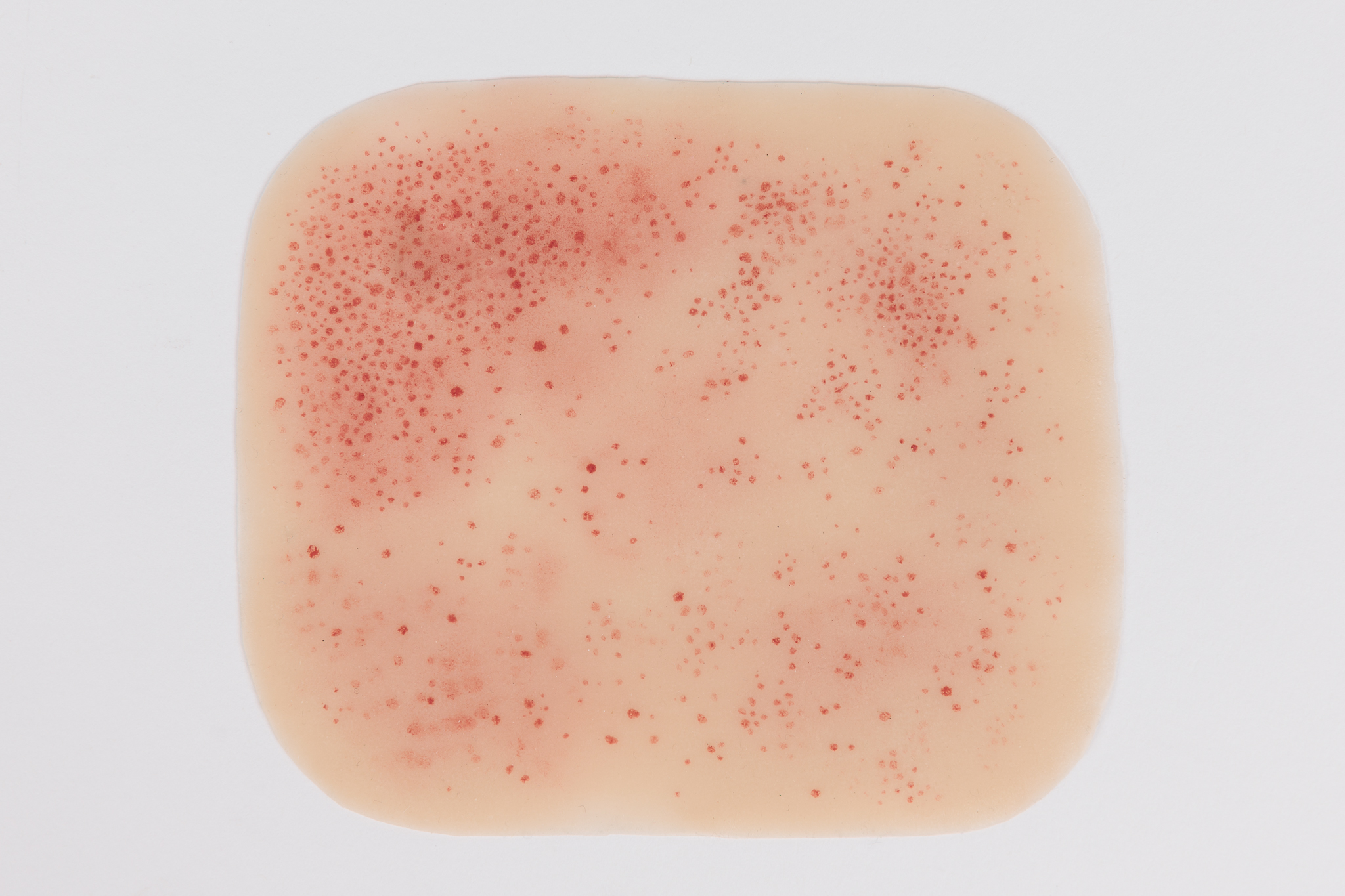 Clinical Rash and Hives Range - Image 2