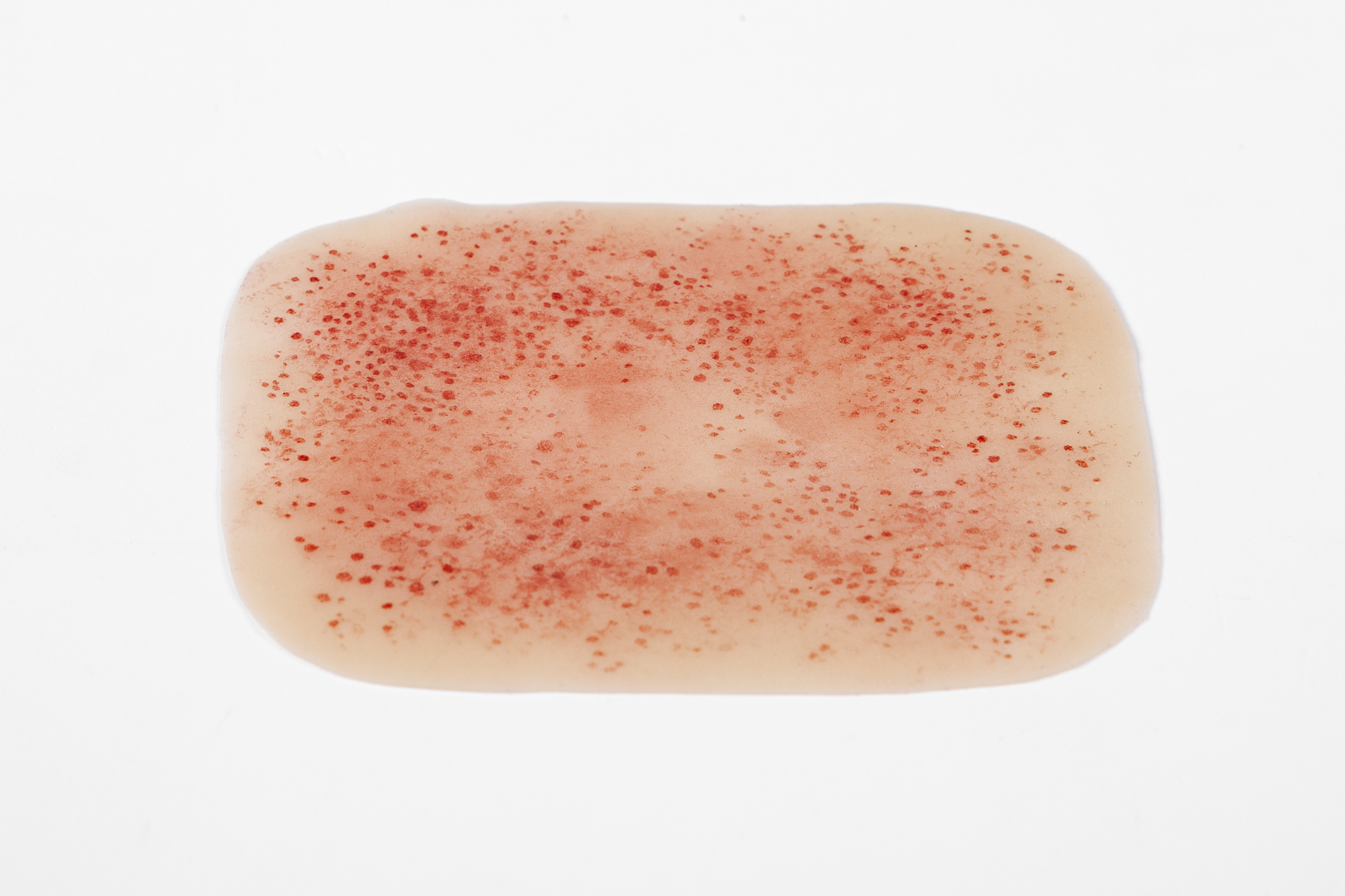 Rash - Meningococcal - Image 4