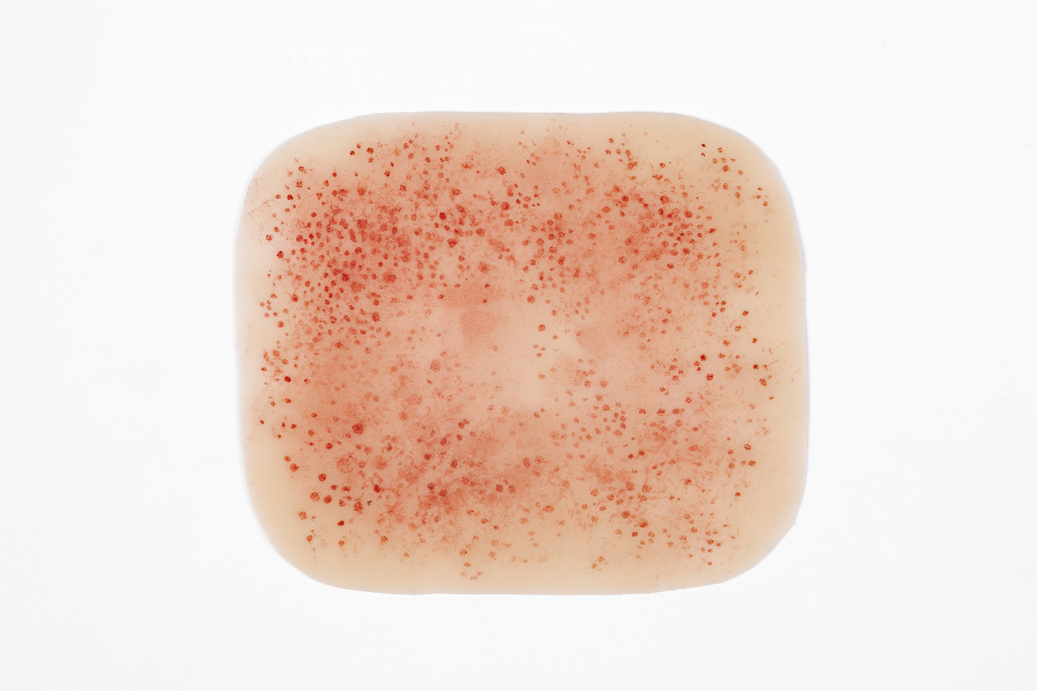 Rash - Meningococcal - Image 3