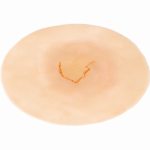Skin Tear Category 1A