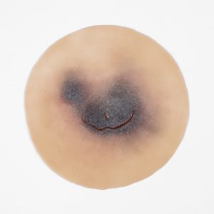 Skin Tear Category 1B