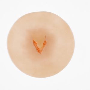 Skin Tear Category 2A
