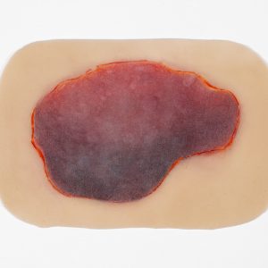 Skin Tear with Mobile Skin