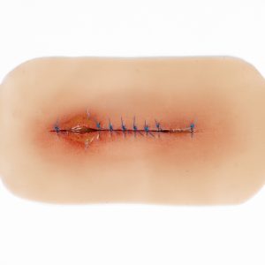 Suture Line Infected