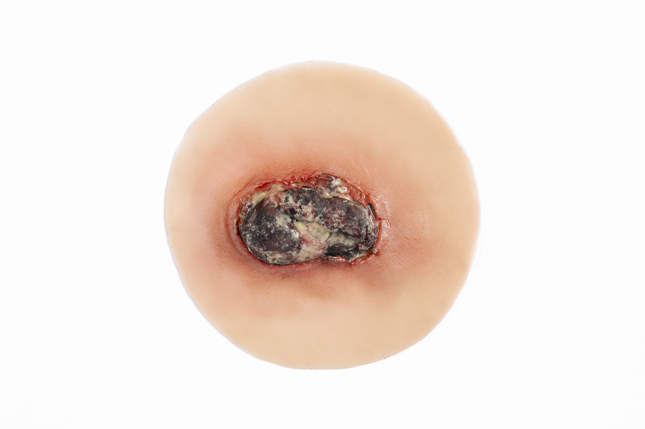 Malignancy - Fungating - Image 2