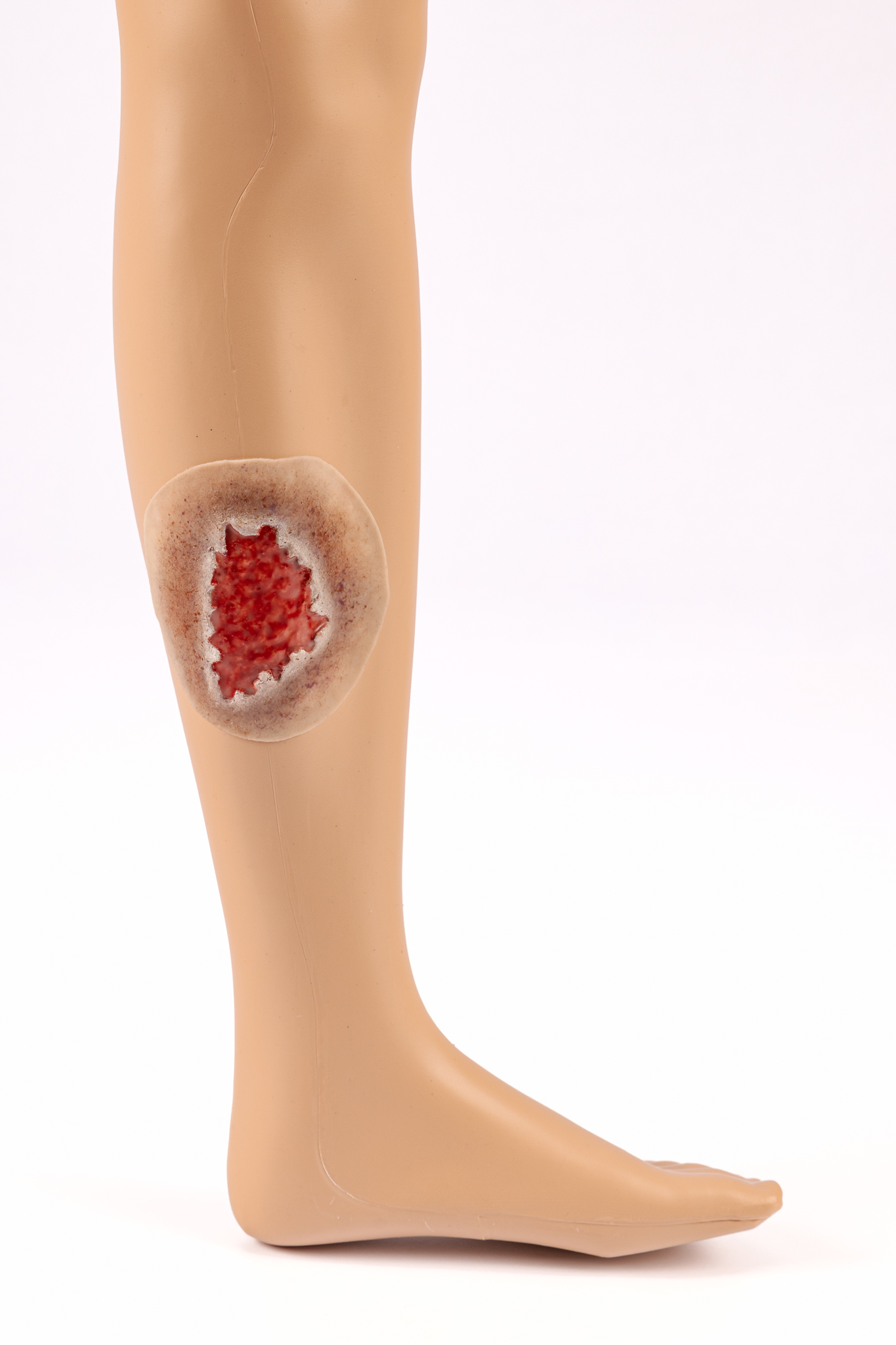 Ulcer - Leg Venous - Image 3