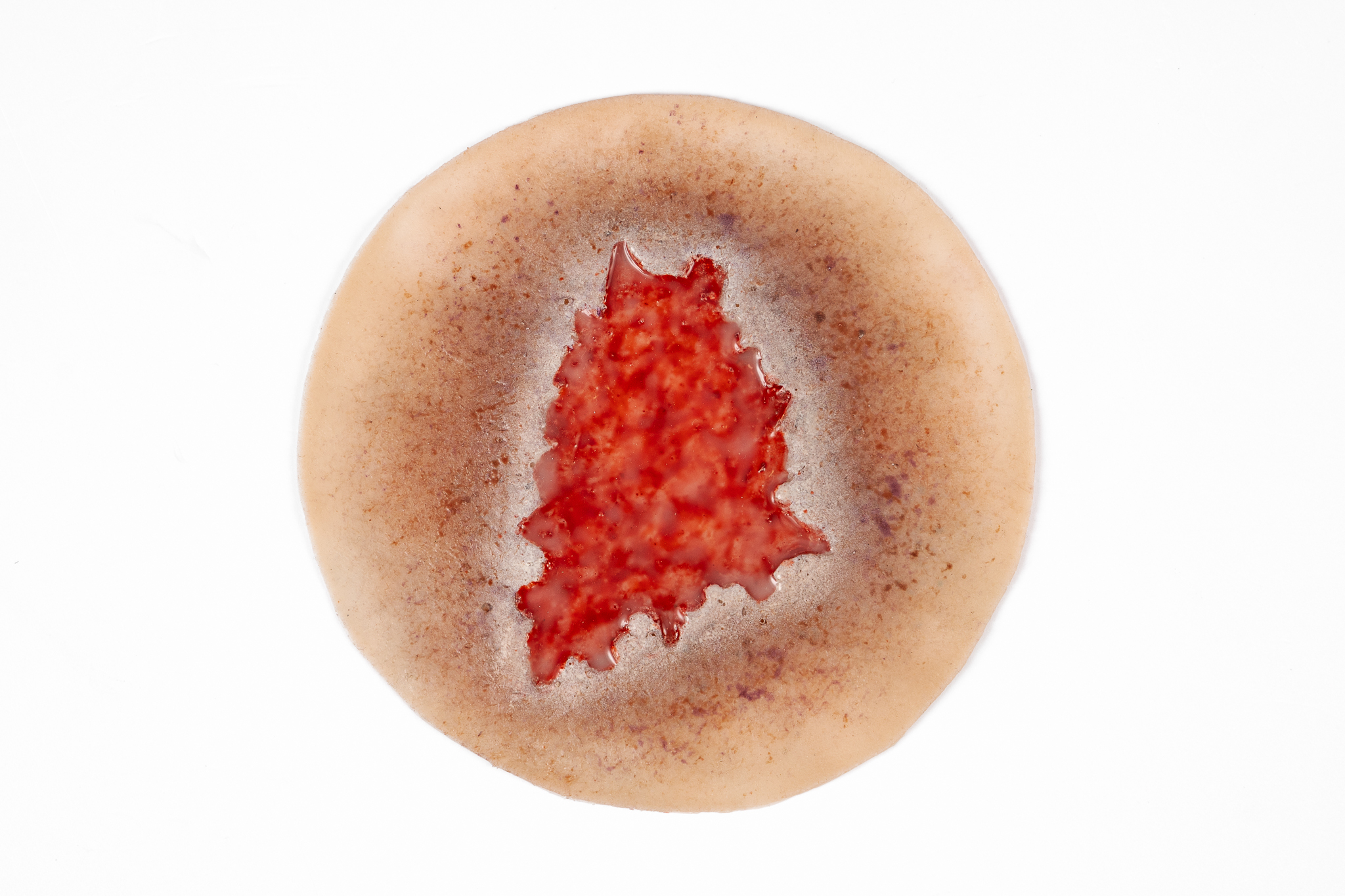 Ulcer - Leg Venous