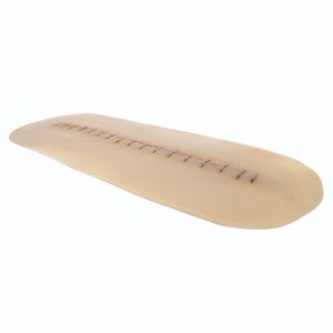 Suture Stapled Healing Large