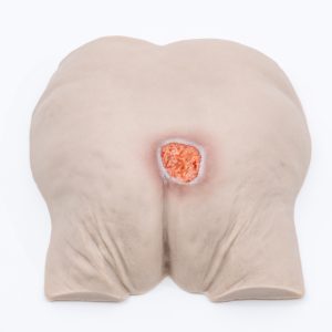 Pressure Injury Buttock Overlay – Stage 2