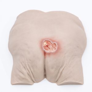 Pressure Injury Buttock Overlay - Stage 3